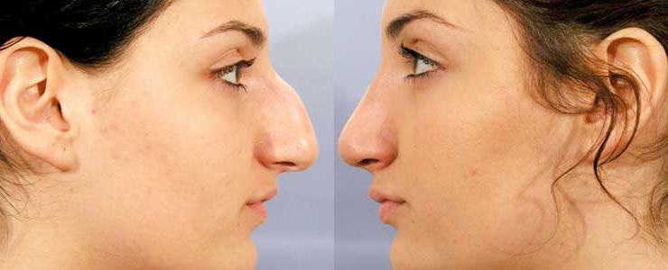 RHINOPLASTIE ESTHETIQUE