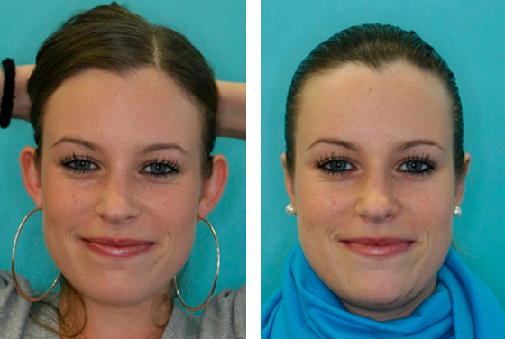 Otoplastie – Chirurgie des oreilles décollées