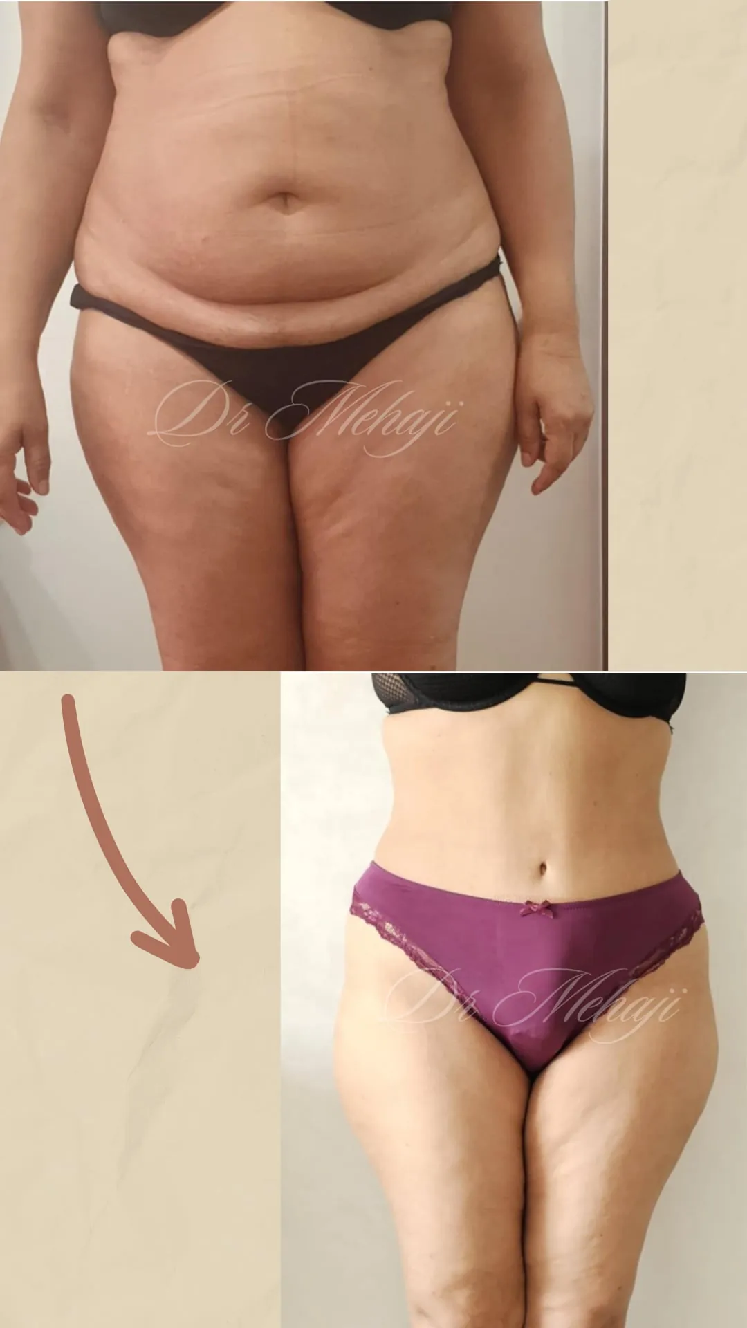 Abdominoplastie