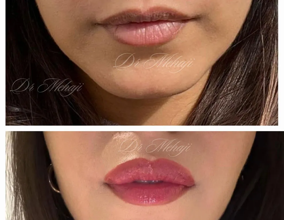 Blepharoplastie