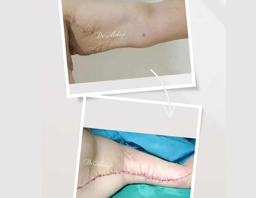 Liposuccion Chez Lhomme